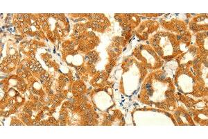 Immunohistochemistry of paraffin-embedded Human thyroid cancer using NAPA Polyclonal Antibody at dilution of 1:35 (NAPA Antikörper)