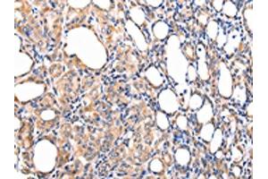 The image on the left is immunohistochemistry of paraffin-embedded Human thyroid cancer tissue using ABIN7190092(CCL7 Antibody) at dilution 1/20, on the right is treated with synthetic peptide. (CCL7 Antikörper)
