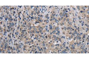 Immunohistochemistry of paraffin-embedded Human liver cancer using MCM3AP Polyclonal Antibody at dilution of 1:30 (GANP Antikörper)