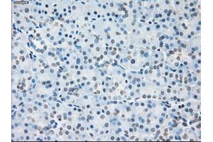 Immunohistochemical staining of paraffin-embedded Adenocarcinoma of colon tissue using anti-SORDmouse monoclonal antibody. (SORD Antikörper)