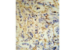FGA Antibody (N-term) (R) IHC analysis in formalin fixed and paraffin embedded human breast carcinoma tissue followed by peroxidase conjugation of the secondary antibody and DAB staining. (FGA Antikörper  (N-Term))