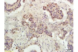 Formalin-fixed and paraffin embedded human ovarian carcinoma labeled with Rabbit Anti-P53 protein(wt-p53) Polyclonal Antibody (ABIN723935), Unconjugated 1:300 followed by conjugation to the secondary antibody and DAB staining