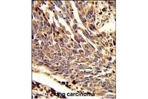 Formalin-fixed and paraffin-embedded human lung carcinoma reacted with ARPC1B Antibody (Center), which was peroxidase-conjugated to the secondary antibody, followed by DAB staining.