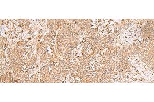 Immunohistochemistry of paraffin-embedded Human ovarian cancer tissue using GMPPB Polyclonal Antibody at dilution of 1:50(x200) (GMPPB Antikörper)