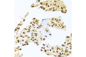 Immunohistochemistry of paraffin-embedded human lung cancer using SMEK1 antibody. (SMEK1 Antikörper  (AA 395-594))