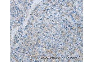 Immunohistochemistry of Human liver cancer using MMP25 Polyclonal Antibody at dilution of 1:80 (MMP25 Antikörper)