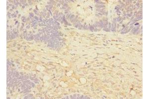 Immunohistochemistry of paraffin-embedded human ovarian cancer using ABIN7160074 at dilution of 1:100 (MAP4K5 Antikörper  (AA 300-480))