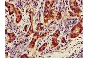 Immunohistochemistry of paraffin-embedded human pancreatic cancer using ABIN7160874 at dilution of 1:100 (NQO1 Antikörper  (AA 55-155))