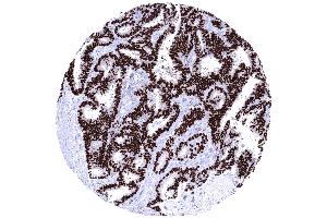 Endometroid carcinoma of the ovary depicting a strong PR immunostaining of all tumor cells (Rekombinanter Progesterone Receptor Antikörper  (AA 1-200))
