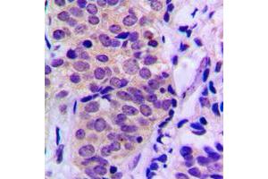 Immunohistochemical analysis of BAD (pS155) staining in human prostate cancer formalin fixed paraffin embedded tissue section. (BAD Antikörper  (C-Term, pSer155))
