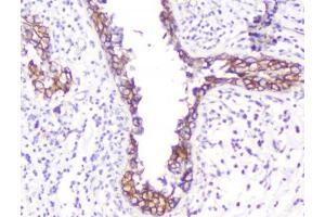 IHC testing of FFPE human breast cancer with Beta Catenin antibody. (beta Catenin Antikörper  (AA 2-233))