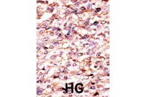 Formalin-fixed and paraffin-embedded human hepatocellular carcinoma tissue reacted with ACVR1C polyclonal antibody  , which was peroxidase-conjugated to the secondary antibody, followed by AEC staining. (ACVR1C/ALK7 Antikörper  (N-Term))