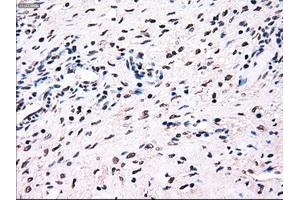 Immunohistochemical staining of paraffin-embedded colon tissue using anti-BRAFmouse monoclonal antibody. (BRAF Antikörper)
