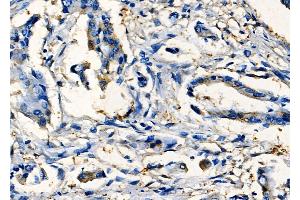 ABIN6265096 and ABIN6277789 at 1/100 staining Human colorectal cancer by IHC-P. (SIX2 Antikörper  (Internal Region))