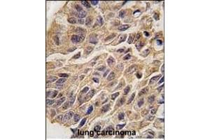 Formalin-fixed and paraffin-embedded human lung carcinoma tissue reacted with INDO antibody (C-term) (ABIN389194 and ABIN2839357) , which was peroxidase-conjugated to the secondary antibody, followed by DAB staining. (IDO1 Antikörper  (C-Term))