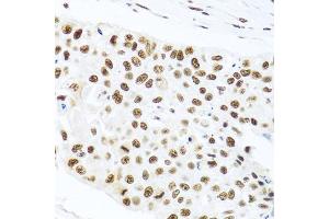 Immunohistochemistry of paraffin-embedded human lung cancer using PRPF19 antibody. (PRP19 Antikörper)