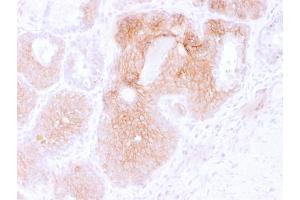 Formalin-fixed, paraffin-embedded human Prostate Carcinoma stained with CD44v6 Mouse Monoclonal Antibody (CD44V6/2496). (CD44 Antikörper)