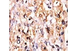 IHC analysis of FFPE human hepatocarcinoma tissue stained with the GCN2 antibody (GCN2 Antikörper  (AA 1-30))