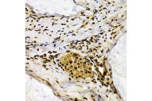 Immunohistochemistry of paraffin-embedded human colon carcinoma using IFIH1 antibody (ABIN5971229) at dilution of 1/200 (40x lens). (IFIH1 Antikörper)
