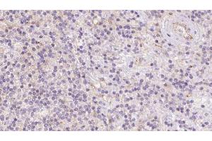 ABIN6273088 at 1/100 staining Human lymph cancer tissue by IHC-P. (ACADVL Antikörper  (Internal Region))
