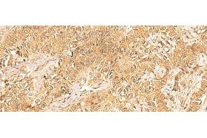Immunohistochemistry of paraffin-embedded Human ovarian cancer tissue using TRMT112 Polyclonal Antibody at dilution of 1:30(x200) (TRMT112 Antikörper)