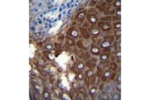 Immunohistochemistry analysis in formalin fixed and paraffin embedded human esophageal carcinoma reacted with MMP1 Antibody (Center) followed by peroxidase conjugation of the secondary antibody and DAB staining.