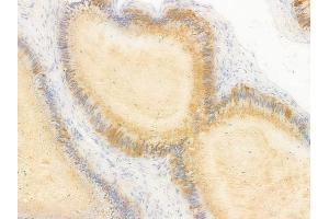ABIN7096897 and ABIN7100963 at 1/100 staining human testicular cancer by IHC-P. (NAA30 Antikörper)