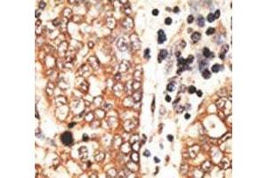 IHC analysis of FFPE human hepatocarcinoma tissue stained with the NRG2 antibody (Neuregulin 2 Antikörper  (AA 830-855))