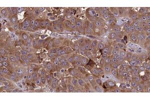 ABIN6273702 at 1/100 staining Human liver cancer tissue by IHC-P. (Cyclin M3 Antikörper  (Internal Region))