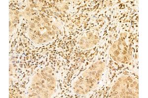 ABIN6265927 and ABIN6273024 at 1/100 staining Human lung cancer by IHC-P. (USP39 Antikörper  (N-Term))