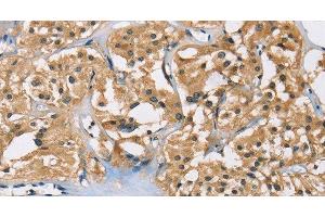 Immunohistochemistry of paraffin-embedded Human thyroid cancer using PPP3CA Polyclonal Antibody at dilution of 1:40 (PPP3CA Antikörper)