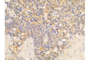 ABIN7094660 and ABIN7098711 at 1/100 staining human glioblastoma by IHC-P.