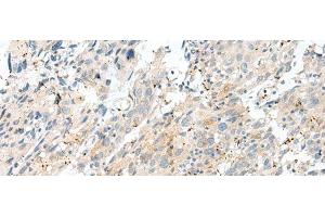 Immunohistochemistry of paraffin-embedded Human cervical cancer tissue using NXNL1 Polyclonal Antibody at dilution of 1:45(x200) (NXNL1 Antikörper)