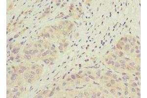 Immunohistochemistry of paraffin-embedded human liver cancer using ABIN7165663 at dilution of 1:100 (PHF17 Antikörper  (AA 543-842))
