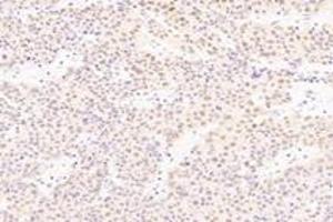 Immunohistochemistry analysis of paraffin-embedded human liver cancer using SRFBP1 (ABIN7075579) at dilution of 1: 2000 (SRFBP1 Antikörper)