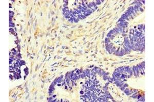 Immunohistochemistry of paraffin-embedded human ovarian cancer using ABIN7149154 at dilution of 1:100 (COX1 Antikörper  (AA 474-513))