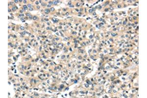 The image on the left is immunohistochemistry of paraffin-embedded Human liver cancer tissue using ABIN7128031(THAP2 Antibody) at dilution 1/20, on the right is treated with fusion protein. (THAP2 Antikörper)