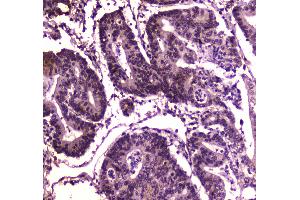 IHC analysis of BRG1 using anti-BRG1 antibody . (SMARCA4 Antikörper  (AA 555-763))