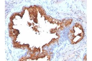 Formalin-fixed, paraffin-embedded human Prostate Carcinoma stained with PSA Rabbit Recombinant Monoclonal Antibody (KLK3/2871R). (Rekombinanter Prostate Specific Antigen Antikörper)
