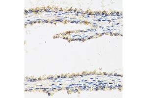 Immunohistochemistry of paraffin-embedded human prostate using SPINT1 antibody (ABIN5973812) at dilution of 1/100 (40x lens). (SPINT1 Antikörper)