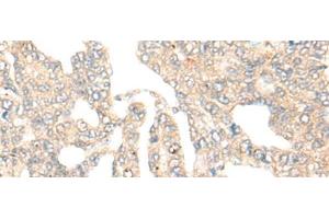 Immunohistochemistry of paraffin-embedded Human liver cancer tissue using DCP2 Polyclonal Antibody at dilution of 1:45(x200)