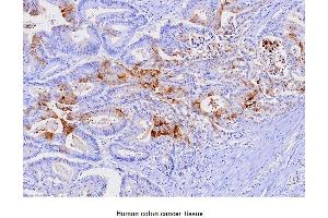 Paraffin embedded sections of human colon cancer tissue were incubated with anti-human FABP1 (1:100) for 2 hours at room temperature. (FABP1 Antikörper  (AA 1-127))