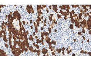 Anaplastic large cell lymphoma: immunohistochemical staining for ALK. (P80 (C-Term), (Catalytic Domain) Antikörper)