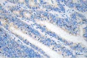 Immunohistochemistry was performed on paraffin-embedded human sigmoid colon carcinoma using CLPX antibody (ABIN7798101), 1:200). (Rekombinanter CLPX Antikörper)
