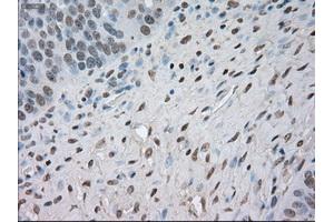 Immunohistochemical staining of paraffin-embedded Adenocarcinoma of colon tissue using anti-NAT8mouse monoclonal antibody. (NAT8 Antikörper)