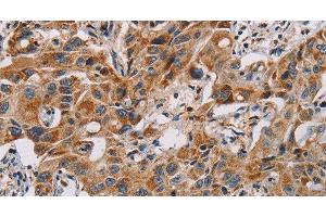 Immunohistochemistry of paraffin-embedded Human lung cancer using MMP1 Polyclonal Antibody at dilution of 1:60 (MMP1 Antikörper)
