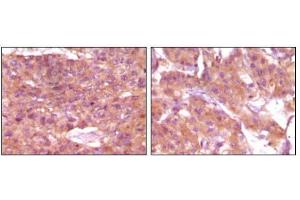 Immunohistochemical analysis of paraffin-embedded human skin carcinoma (left) and breast carcinoma (right), showing cytoplasmic and membrane localization using SRA mouse mAb with DAB staining. (SRA1 Antikörper)