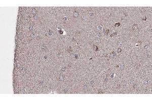 ABIN6276691 at 1/100 staining Human brain cancer tissue by IHC-P.