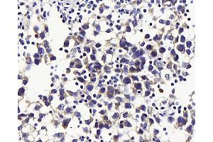 Immunohistochemistry analysis of paraffin-embedded human testis cancer using GLUT-3 Polyclonal Antibody at dilution of 1:300. (SLC2A3 Antikörper)