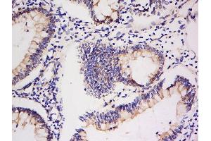Formalin-fixed and paraffin embedded human colon carcinoma labeled with Anti-Integrin Alpha V + Beta 5 Polyclonal Antibody, Unconjugated  at 1:200 followed by conjugation to the secondary antibody and DAB staining. (ITGAV/ITGB5 Antikörper)